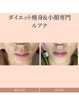 ルアナ(Luana.)/フェイスシャル　肌質改善コース