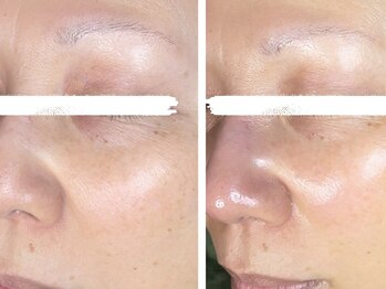 コハク(kohaku)/毛穴洗浄+ララピー b/a