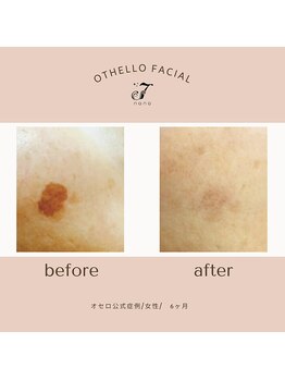 ナナ(nana)/◆before/after◆