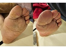 はりきゅう和 ルート鍼灸院/足の鍼