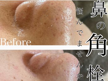 グレイティア(gratia)/角栓・詰まり改善!毛穴洗浄!!