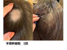 ボニータ(Bonita)/【頭皮Lit】ヒト羊膜幹細胞