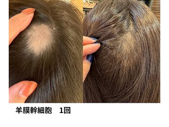 ボニータ(Bonita)/【頭皮Lit】ヒト羊膜幹細胞