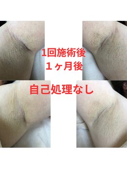 ヒカリ(Hikari)/1回でも効果を実感!!