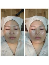 アクア(AQUA)/内臓から引き上げる小顔調整