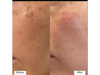 トゥルリア(TRULIA)/ピコスポット