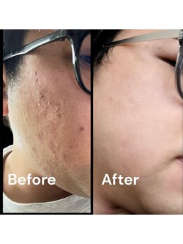 ブライトプラス(BRIGHT+)/肌質改善