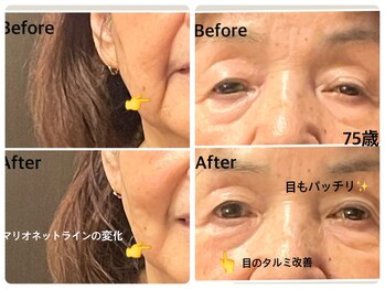 サロン ド ジョワ(salon de joie)/マリオネット改善！目もパッチリ