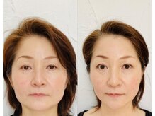 グラナーダ(granada)/二重顎にアプローチ