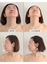 オラ(Ola)/40代/1回目施術後