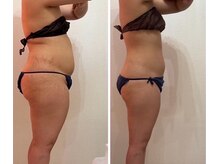 ピエルポゼ(Piereposer)の雰囲気（痩身before /after）