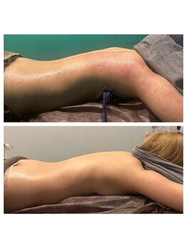 プティットスリール エステティック 栄本店(Petit Sourire Esthetic)の写真/痩せにくくなってきた方必見！しぶといムダ肉を撃退！【ハイパーナイフ半身+セル撃退マシン半身¥12800】