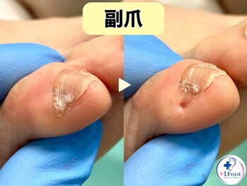 プラスワンフット 本厚木(+1 Foot)/痛い・引っかかる・邪魔な副爪に
