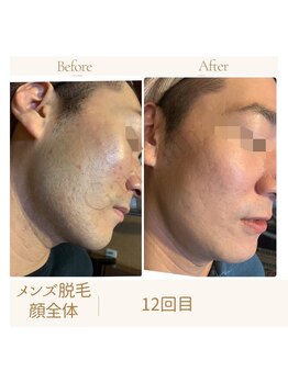 ガムラン(Gamelan)/メンズ脱毛顔全体（12回目）