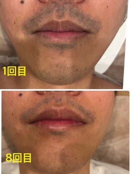 ルイ(Rui)/髭脱毛UOMOのIPL脱毛で早期脱毛