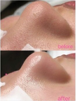 マリヴェリーテ(Mari verite)/毛穴洗浄【8回】