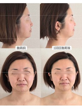 オラ(Ola)/40代/むくみ・たるみ悩み・小顔