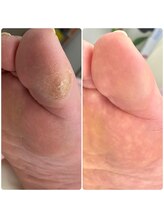 名古屋巻き爪専門Pro/タコ魚の目