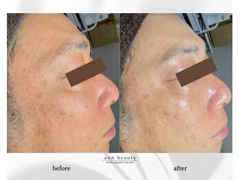アン ビューティー(ann beauty)/施術1回【症例写真】40代