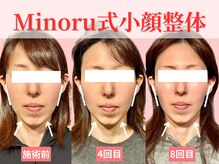 フレキシボディ(FlexiBody)/小顔施術ビフォーアフター #5