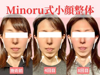 フレキシボディ(FlexiBody)/小顔施術ビフォーアフター #5