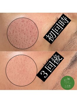 エマ(emma)/汚れを取ってハーブで引き締める