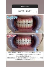 エクシア ホワイトニング 鶴岡店/Before→After