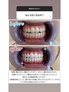 エクシア ホワイトニング 鶴岡店/Before→After