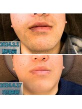 ラフ(LaFF)/ヒゲ脱毛Before＆After