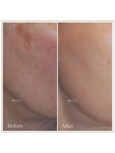 ベルタ(BELTA)/ケア前→5ヶ月後　シミ/赤み