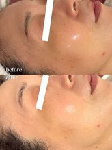 ルミナス(Luminous)/ララピールのbeforeとafter