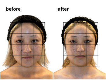 青空 天神大名店(SORA)/ハチ張りもスッキリ！速攻小顔に