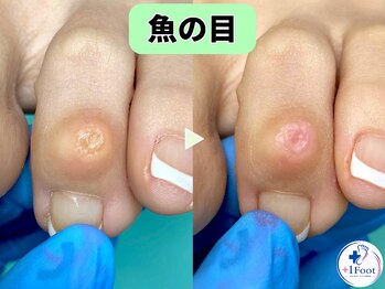 プラスワンフット 本厚木(+1 Foot)/タコ・魚の目ケア！痛みから解放