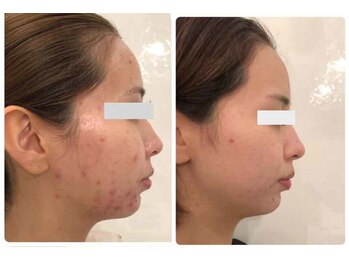 アネル 新都心店(anel)/毛穴洗浄　肌質改善　《那覇》　