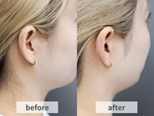 アルムボーテ 代官山 恵比寿(ARUIM Beaute)/シェービングビフォーアフター