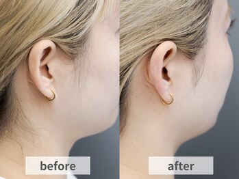 アルムボーテ 代官山 恵比寿(ARUIM Beaute)/シェービングビフォーアフター