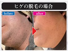マンモス 赤羽店の雰囲気（押し売りなし！ご予算に沿った脱毛プランをご提案いたします。）