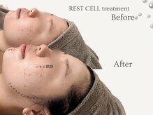 お肌の細胞を根本から育てるリアボーテ肌質改善フェイシャル