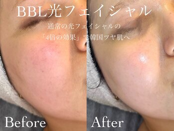 ルチーレ(Lucire)/BBL 1回目