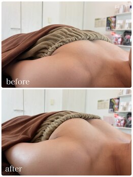 リノ 行橋(lino)/◇バストアップ症例◇20代