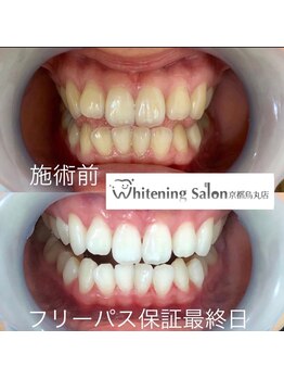 ホワイトニングサロン 京都烏丸店/ホワイトニング施術例