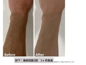 中国整体リラクゼーション 桜月/腕と手の脱毛