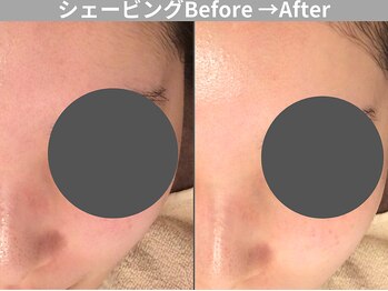 ももとゆでたまご/顔剃り ビフォーアフター/新宿