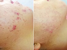 ハダイ(HADAY)/ニキビ改善｜ハーブピーリング