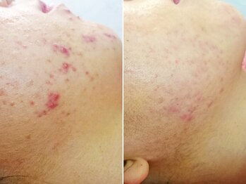 ハダイ(HADAY)/ニキビ改善｜ハーブピーリング