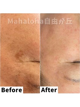 マハロハ 自由が丘(Mahaloha)/【シミケア・くすみ改善施術】