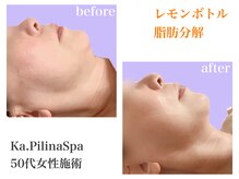 カピリナスパ(Ka.Pilina Spa)/レモンボトル　before⇒after