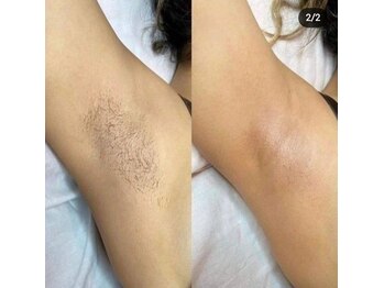 シュガーリングハウスレディ(SugaringHouse LADY)/わき脱毛