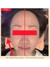 【しわ・たるみ・ほうれい線改善、若々しい第一印象へ】¥15500→初回¥10800