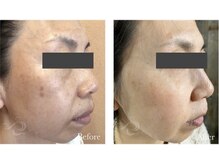 シックスティーエイトフェスター(68FESTAR★)/シミ改善大得意です！